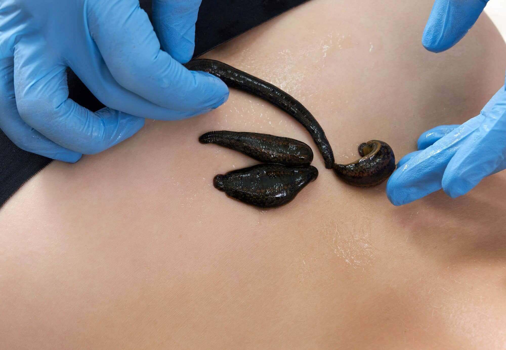 Leech therapy in Istanbul - Dr. Muhsine Zeynep Yavuz