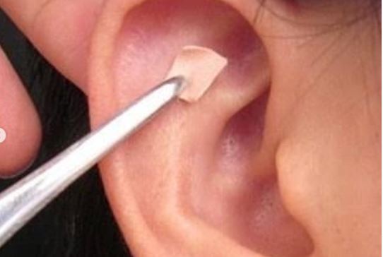 weight loss with acupuncture