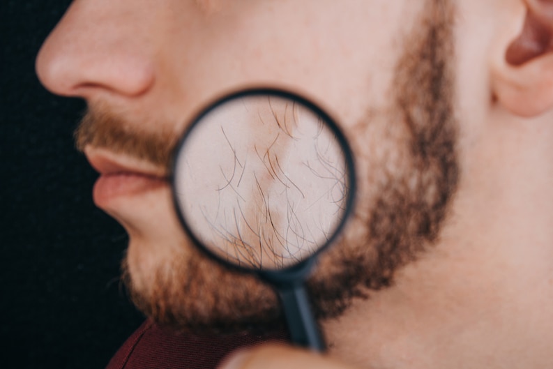 Beard Transplant