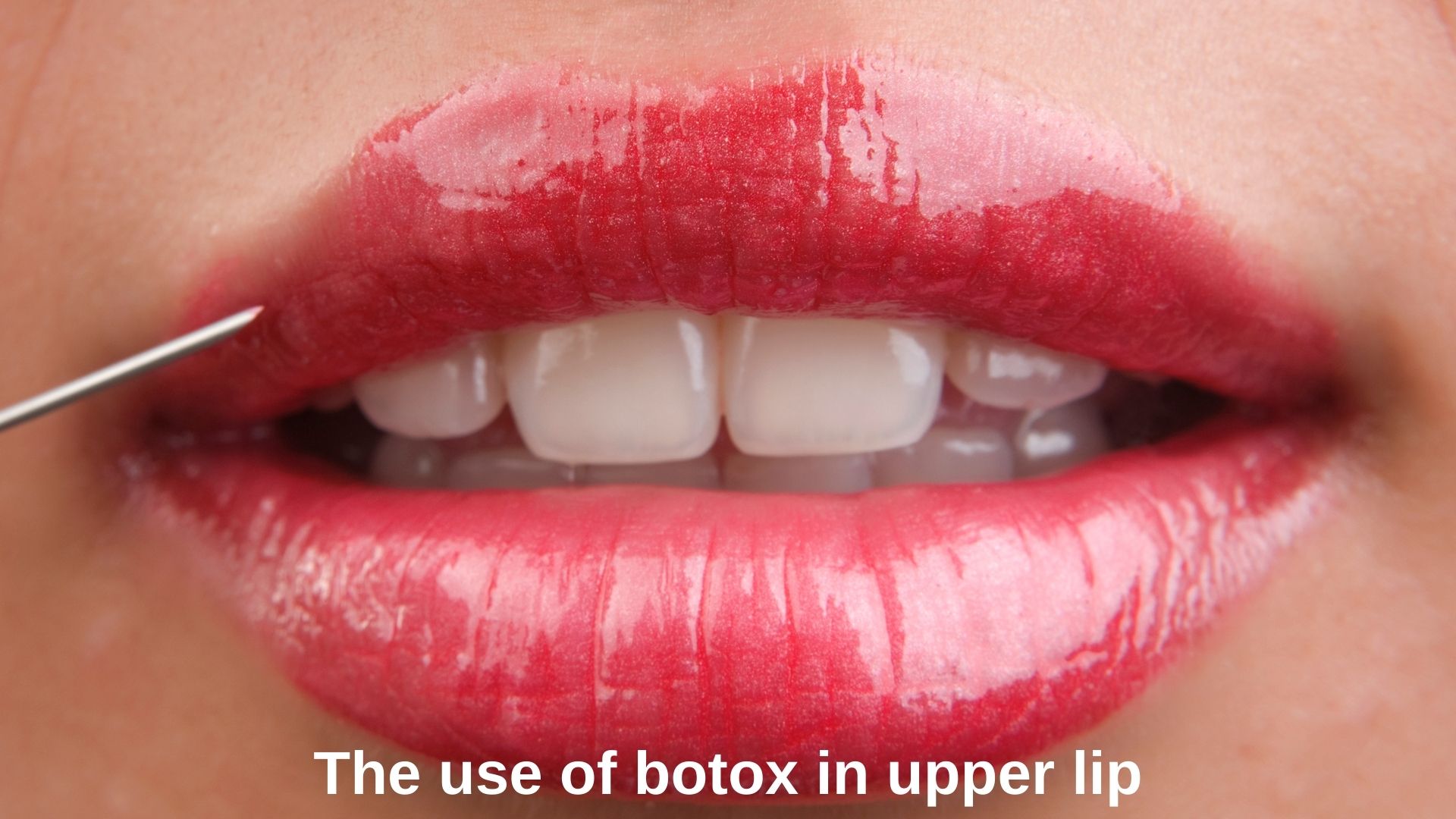 The use of botulinum toxin in upper lip in Istanbul