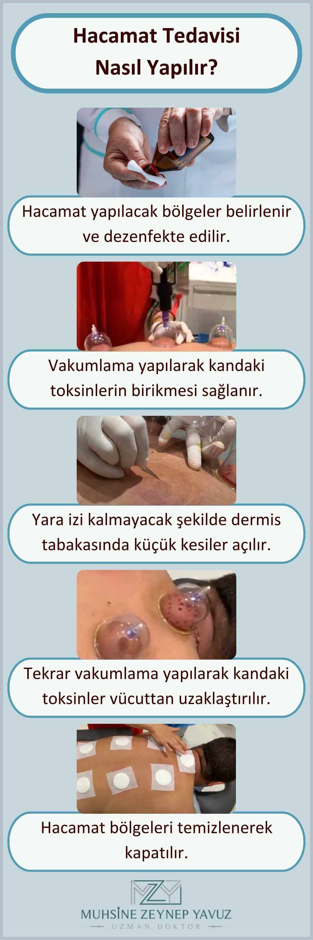 Hacamat Tedavisi Nasıl Yapılır? Fiyatları İstanbul Nişantaşı