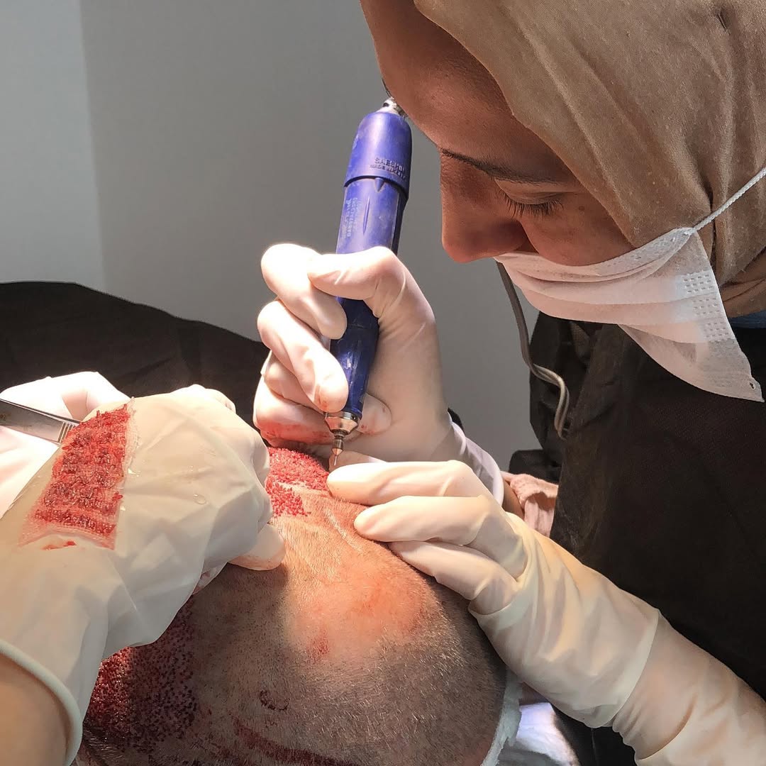 Frequently Asked Questions about Hair Transplantation in Istanbul