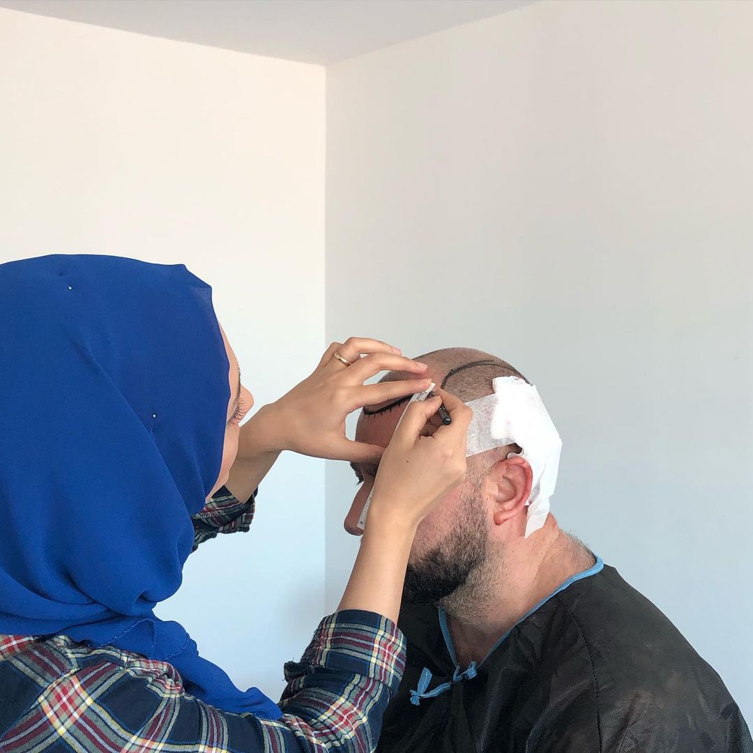 Hair Transplant