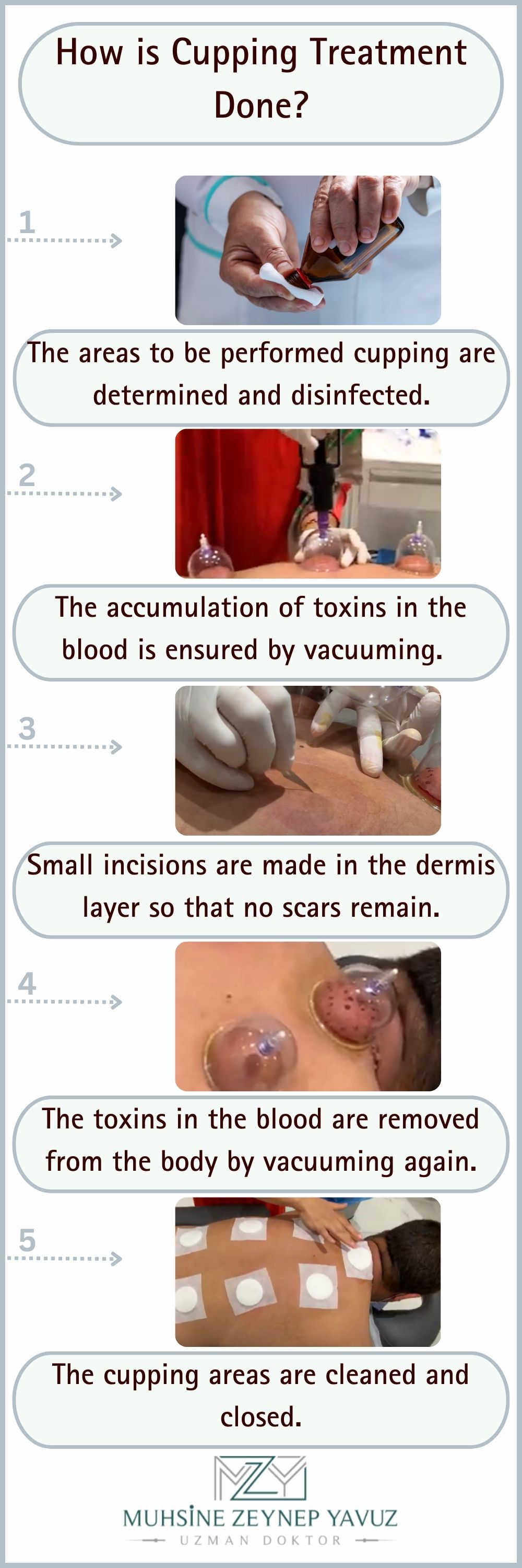 How is Cupping Treatment
              Done?