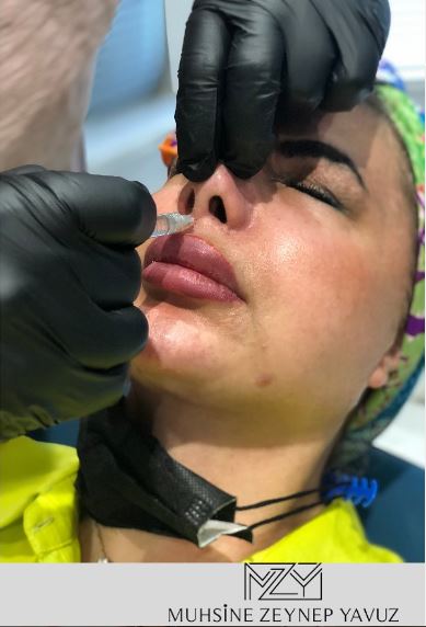 nose filler treatment - enhancing facial features with dermal fillers