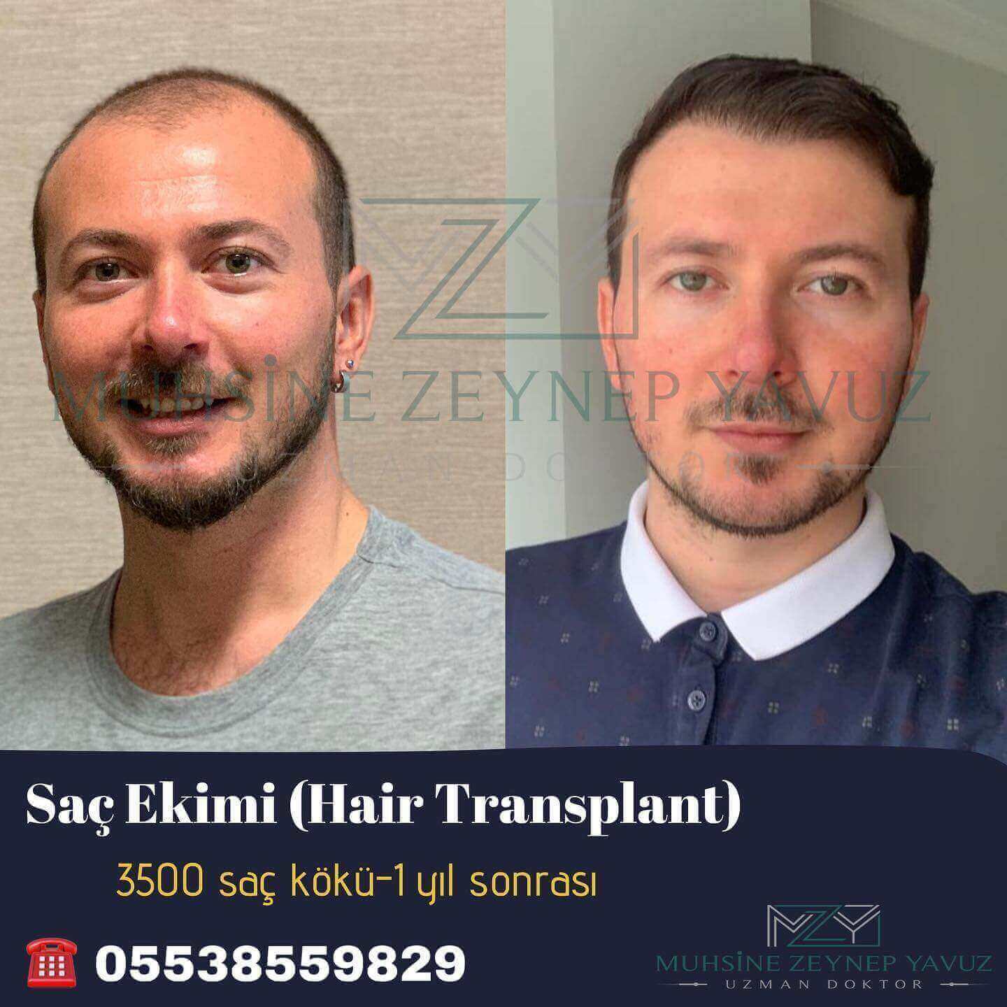 Saç Ekimi Öncesi, Sonrası, fiyatları İstanbul